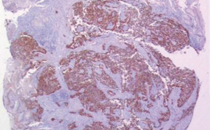 Une étude appuie la résection de la tumeur primitive dans le cadre du carcinome neuroendocrine gastrique de stade IV