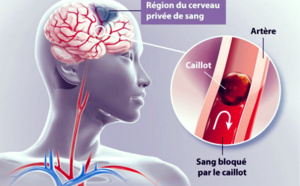 AVC (Accident Vasculaire Cérébral) : Causes, Symptômes et Traitements