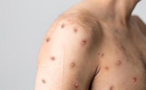 FAQ Monkeypox ou variole du singe : savoir repérer et orienter