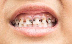  Bambey affiche une "forte prévalence" de la carie dentaire chez les enfants (médecin)