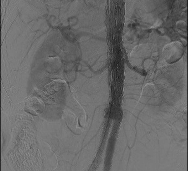 L’intelligence artificielle pour le suivi des patients bénéficiant d’une endoprothèse aortique