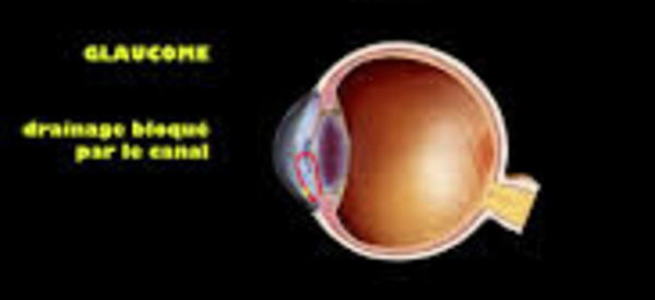 Glaucome à angle ouvert : et s’il fallait un traitement initial d’emblée intensif ?