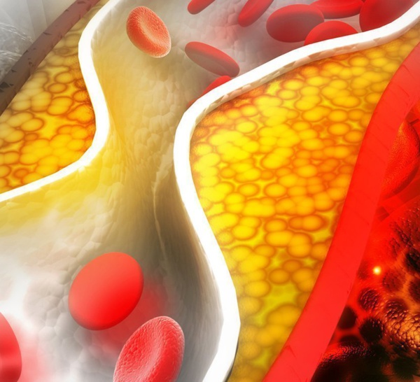L’alirocumab stabiliserait la plaque d’athérome