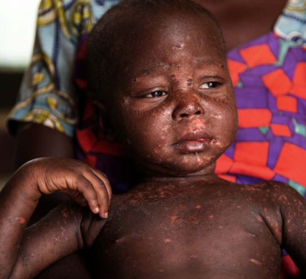 Vers une flambée épidémique de rougeole ?