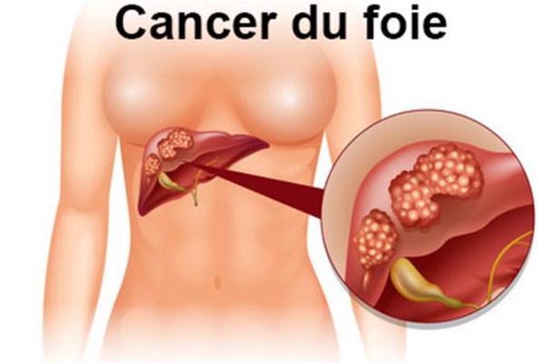 JFHOD 2023 : Le syndrome métabolique devenu deuxième cause de cancer du foie