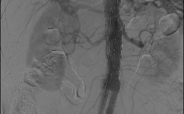 L’intelligence artificielle pour le suivi des patients bénéficiant d’une endoprothèse aortique