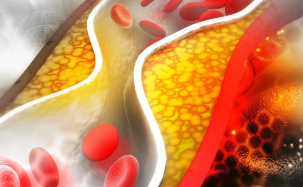 L’alirocumab stabiliserait la plaque d’athérome