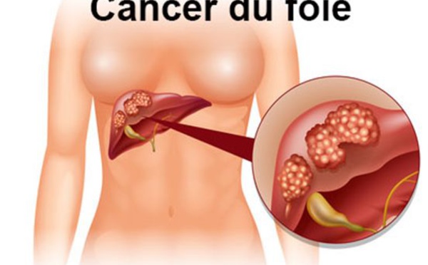 JFHOD 2023 : Le syndrome métabolique devenu deuxième cause de cancer du foie