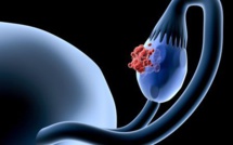 Cancer de l’ovaire : la chimiothérapie hebdomadaire à dose dense échoue lors d’un essai de phase III