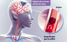 AVC (Accident Vasculaire Cérébral) : Causes, Symptômes et Traitements