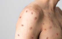 FAQ Monkeypox ou variole du singe : savoir repérer et orienter