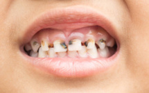  Bambey affiche une "forte prévalence" de la carie dentaire chez les enfants (médecin)